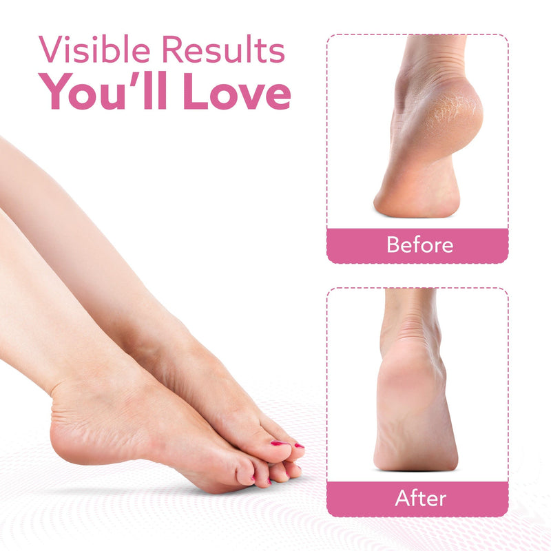 AGARO Callus Remover Replaceable Heads, 2 Pcs, Callus & Dead Skin Removal Filer, Pedicure at Home